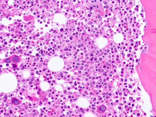 Xơ hóa tủy nguyên phát - Hình ảnh minh họa